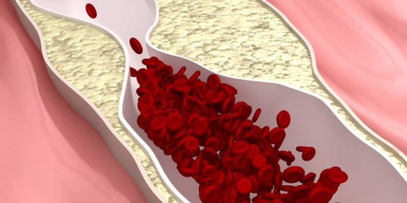 Canagliflozin reduziert Arteriosklerose und moduliert entzündliche, oxidative Wege bei Mäusen