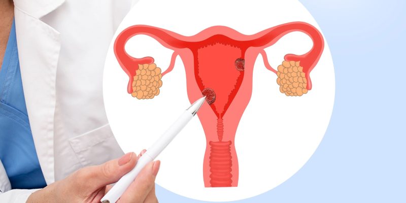 Genetik der Östrogenproduktion im Zusammenhang mit dem Endometriumkrebsrisiko bei postmenopausalen Frauen