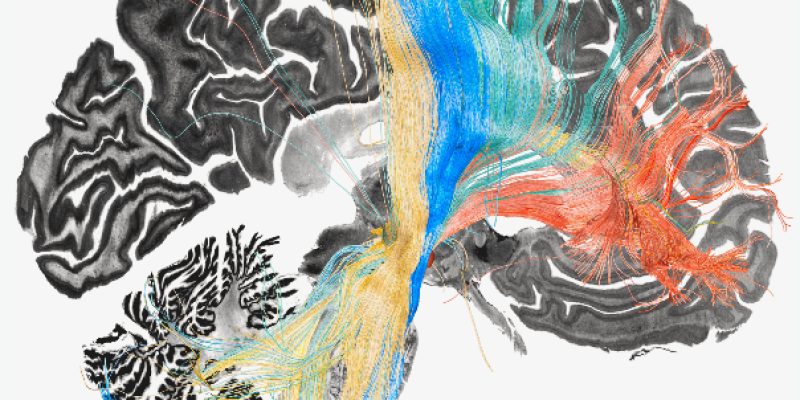 Verwendung der Tiefenhirnstimulation zur Kartierung dysfunktionaler Hirnschaltkreise, die mit vier Störungen in Zusammenhang stehen