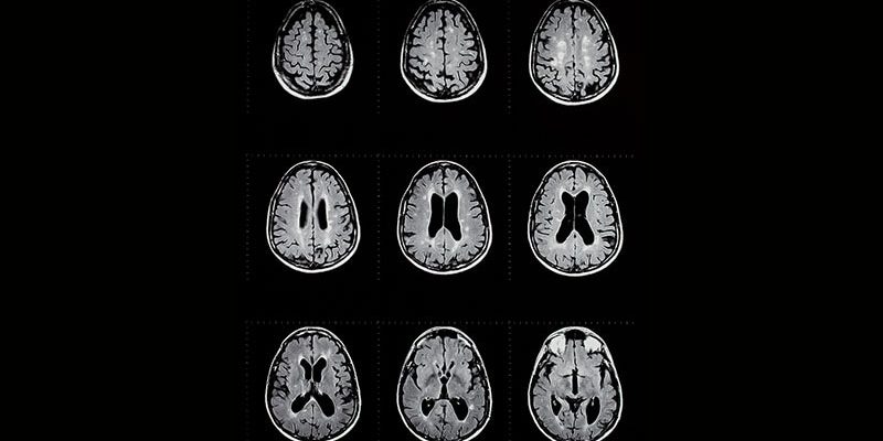 Hochwirksame Erstlinientherapie besser für pädiatrische MS