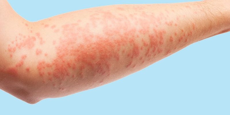 EMA genehmigt Tx für Psoriasis und andere Autoimmunerkrankungen