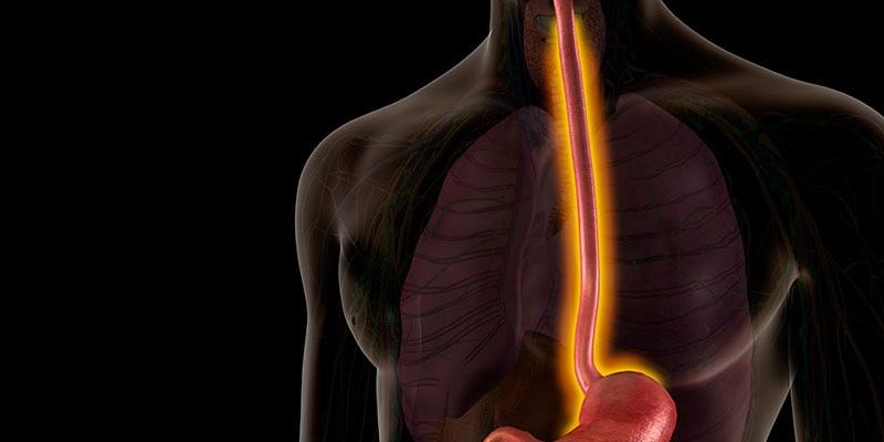 Eosinophile Ösophagitis: 5 Dinge, die Sie wissen sollten