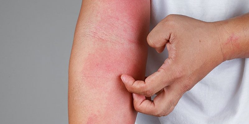 Paradoxes Ekzemrisiko gering mit biologischem Psoriasis-Tx