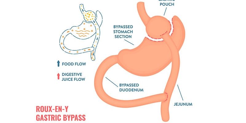 Der Magenbypass steigert die T2D-Remission, auch bei Gewichtszunahme