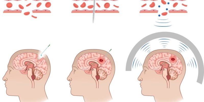 Umriss der Zukunft der Theranostik in der Neuroonkologie