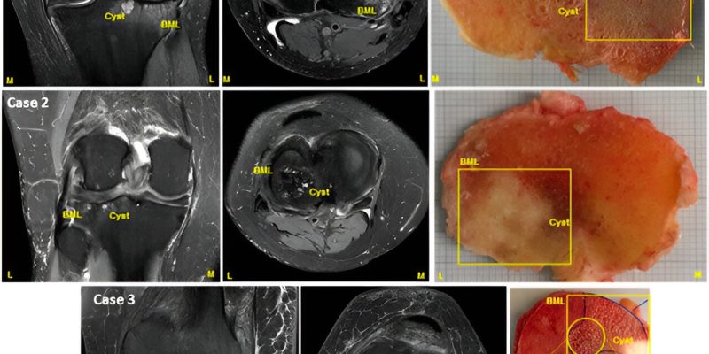 Neues Knochenwerkzeug könnte ein schnelles Screening für neue Behandlungen gegen Schmerzen bei Arthrose ermöglichen