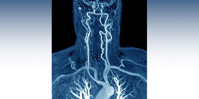 Neue Daten zu Antithrombotika bei der Zervixarteriendissektion