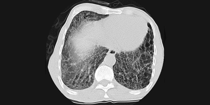 Forscher verstehen RA-assoziierte ILD besser