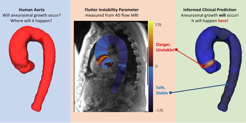 Instabiles „Flattern“ sagt ein Aortenaneurysma mit einer Genauigkeit von 98 % voraus